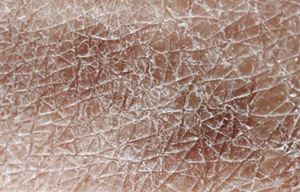 Внутренние и внешние факторы могут нарушать гидратационную способность кожи.